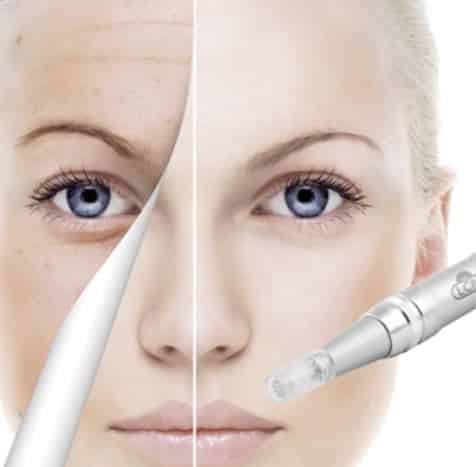 Microneedling